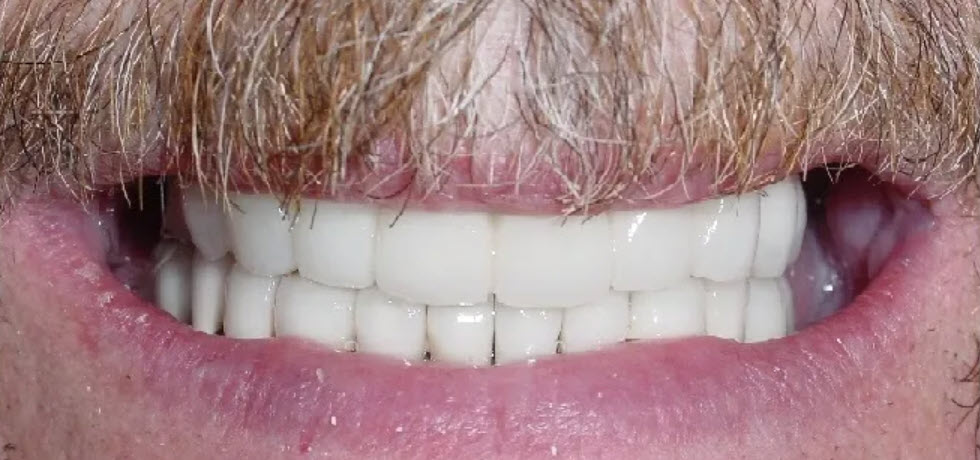 Close-up after picture of the teeth of a patient at Cameron Dental Studio