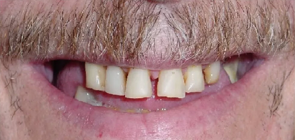 Close-up before picture of the teeth of a patient at Cameron Dental Studio