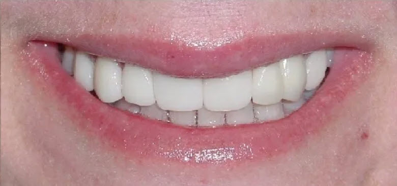 Close-up after picture of the teeth of a patient at Cameron Dental Studio