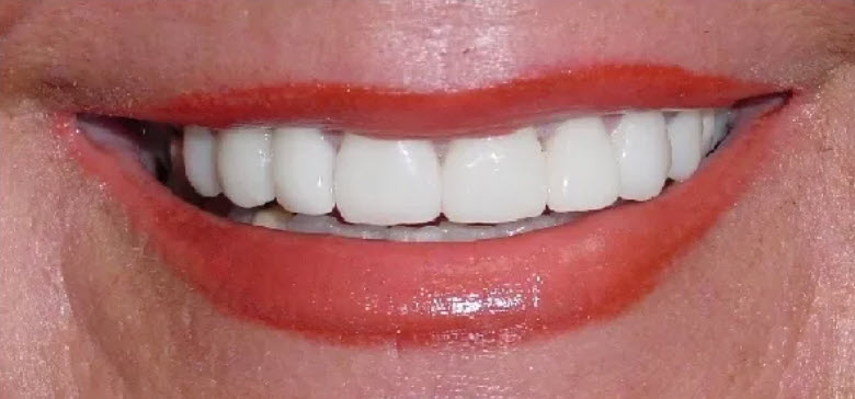 Close-up after picture of the teeth of a patient at Cameron Dental Studio