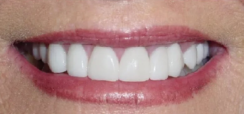 Close-up after picture of the teeth of a patient at Cameron Dental Studio