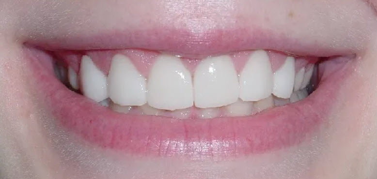 Close-up after picture of the teeth of a patient at Cameron Dental Studio