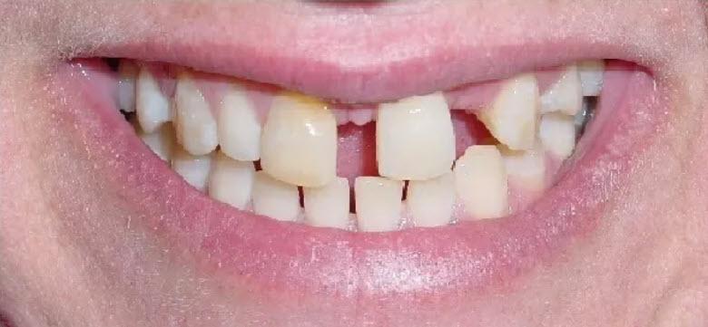 Close-up before picture of the teeth of a patient at Cameron Dental Studio