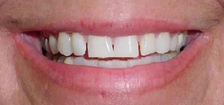 Close up teeth picture of a dental patient of Cameron Dental Studio