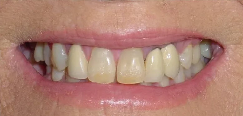 Close up teeth picture of a dental patient of Cameron Dental Studio