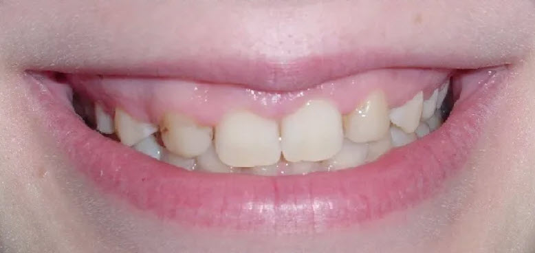 Close up teeth picture of a dental patient of Cameron Dental Studio