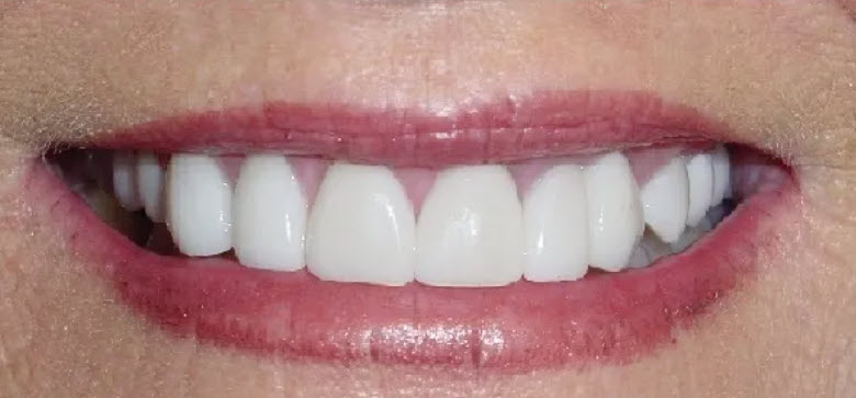 Close-up after picture of the teeth of a patient at Cameron Dental Studio