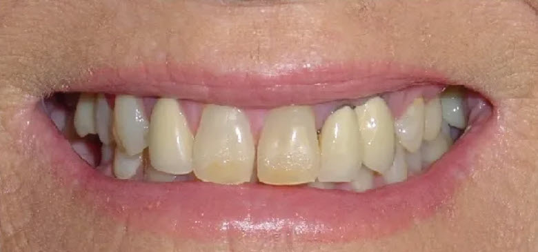 Close-up before picture of the teeth of a patient at Cameron Dental Studio