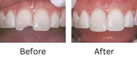 Before and after photos of dental bonding work done by a cosmetic dentist.