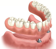 Rendering of a lower set of implant-supported dentures.