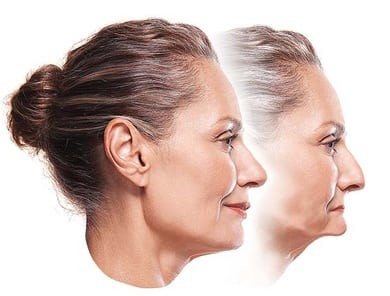 Rendering of a woman's face before and after experiencing facial collapse as a result of bone resorption.