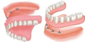 Drawing of a pair of implant-supported dentures that attach via snaps.
