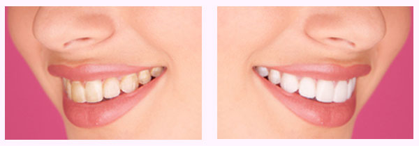 Side-by-side photos of a woman's smile that show the difference teeth whitening can make.