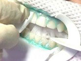 Peroxide gel is applied to a woman's teeth during a Zoom whitening treatment.