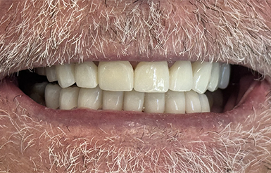 Close-up of Donald's teeth after Dr. Cameron finished his dental work.