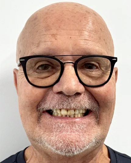 Full-face picture of Donald before Dr. Cameron began his dental work.