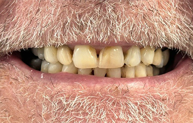 Close-up of Donald's teeth before Dr. Cameron began his dental work.