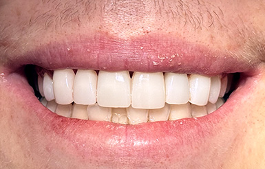 Close-up of Hayden's teeth after Dr. Cameron completed his dental work