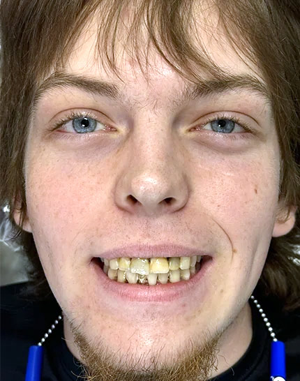 Full-face picture of Hayden before Dr. Cameron began his dental work.