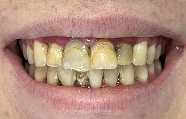 Close-up of Hayden's teeth before Dr. Cameron began his dental work.