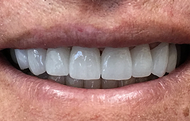 Close-up of Ken's teeth after Dr. Cameron finished his dental work.