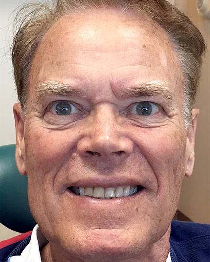 Full-face picture of Ken before Dr. Cameron began his dental work.