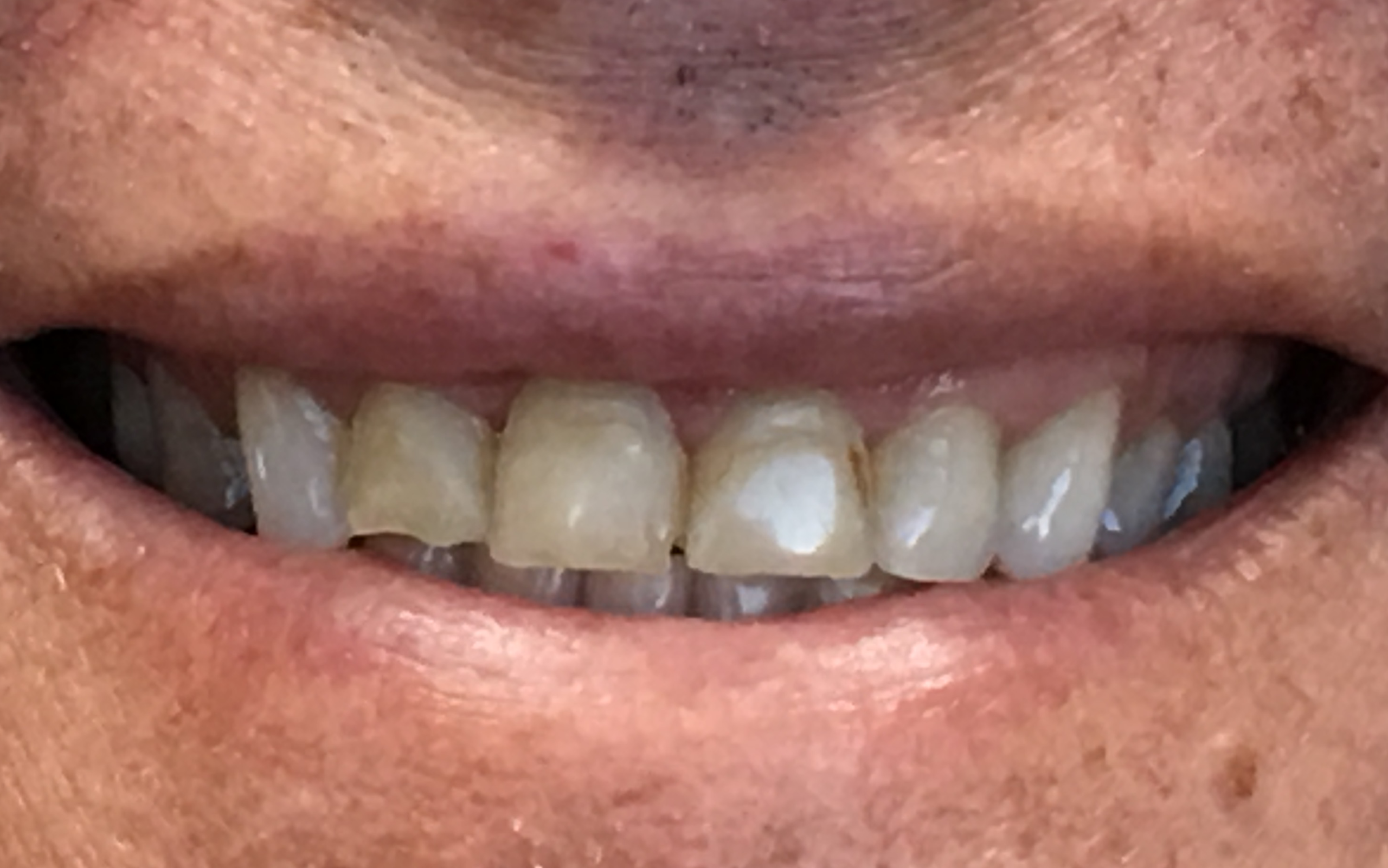 Very Close-up picture of Ken's teeth before Dr. Cameron began his dental work.