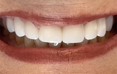 Close-up of Linda's teeth after Dr. Cameron completed her work