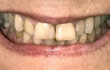 Close-up of Linda's teeth before Dr. Cameron began working on her teeth