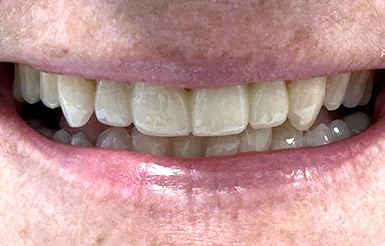 Close-up of Melinda's teeth after Dr. Cameron completed her work