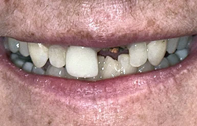 Close-up of Melinda's teeth before Dr. Cameron began working on her teeth