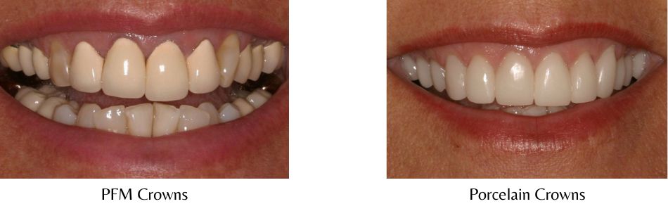 Side-by-side photos showing the aesthetic difference made in a woman's smile before and after her porcelain-fused-to-metal crowns were replaced with all-ceramic ones.