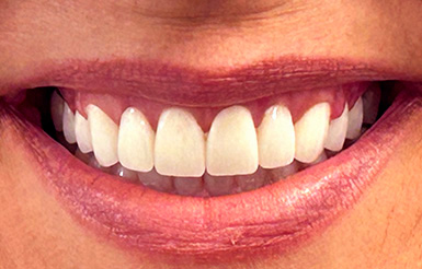 Close-up of Shelly's teeth after Dr. Cameron completed her work