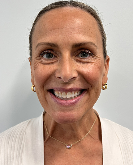 Full-face picture of Shelly before Dr. Cameron began her dental work.