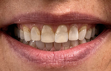 Close-up of Shelly's teeth before Dr. Cameron began working on her teeth