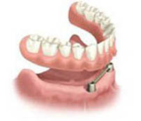Drawing of a lower set of overdentures supported by dental implants.