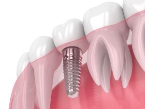 3-D rendering of a dental implant embedded into the jaw and affixed to a natural-looking crown.