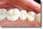 Photo of mercury-free composite fillings.