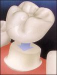 Rendering of a ceramic crown being placed over a prepared tooth.