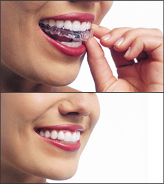 A woman places an Invisalign or ClearCorrect aligner over her teeth.