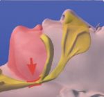 Diagram showing the narrowing of the breathing passage that causes sleep apnea and snoring.