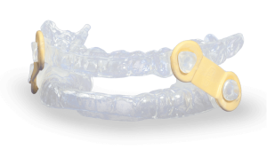 Photo of the Myerson EMA mandibular advancement device, a non-surgical treatment for snoring and sleep apnea.