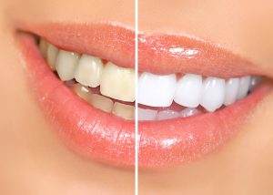 Side-by-side photos show a woman's smile before and after teeth whitening.