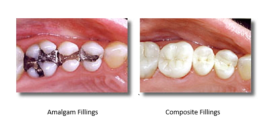 Before and after mercury free fillings