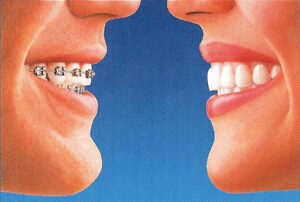 A comparison of braces to Invisalign