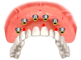 An implant supported denture