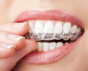 Teeth Whitening Trays